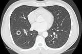 Image of author’s lungs showing a 2 cm lesion in his lower right lobe