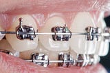 Metal Braces Boca Raton FL