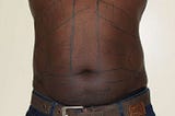 Liposuction in Kenya