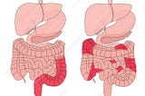 maladie de Crohn