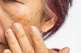 If You’ve Ever Dealt With Melasma, You Should Read This