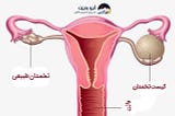 |همه چیز درباره کیست تخمدان|