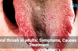 Oral Thrush in Adults: Symptoms, Causes & Treatment