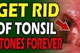 The Simplest Way to Remove Tonsil Stones