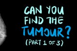 Can You Find the Breast Tumours? (Part 1 of 3)