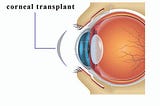 Every thing one needs to know about Corneal Transplant Surgery