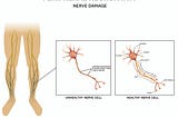 Peripheral Neuropathy, Symptoms, Causes and Treatment