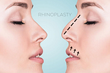 About Rhinoplasty