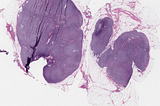 Nodal Mantle Cell Lymphoma, Nodular Growth Pattern