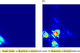 Brief Review — Heart sound classification based on bispectrum features and Vision Transformer mode