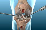 Joint Reconstruction Market Demand, Sales and Consumption Status and Growth Opportunities