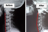 What Is Chiropractic BioPhysics (CBP)?