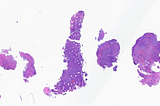 DLBCL in Stomach Biopsy, EBV+, Post Transplant Setting (History of AML)
