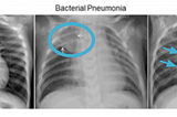 Computer Vision and Pneumonia Detection Part 1: Technical