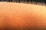 Goosebumps: Unraveling the Mysteries of Our Skin’s Symphony