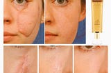 Acne Scar Removal Cream Skin Repair Face Cream Acne Spots Acne Treatment Blackhead Whitening Cream…