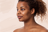 African American Woman with Acne Scars on her face https://www.richcomplexions.com/how-to-get-rid-of-acne-scars/