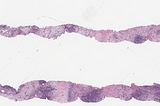 Extra-Nodal, Extra-Nasal EBV-Positive NK/T-Cell Lymphoma