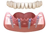 Understanding Dental Implants: Types and Materials Used in India