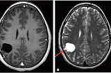 “Classifier Techniques and Tumor Analysis with Artificial Intelligence: Determining the Difference…