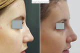 Rhinoplasty Surgery Before and After: Real Results and What to Expect