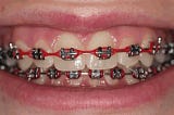 Red Braces: Stylish Orthodontic Option for Dental Health | Abandor