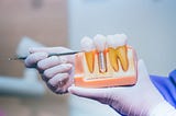 Implanty zębów podczas jednej wizyty