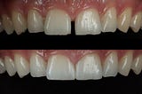 Enhance Your Smile With Composite Bonding