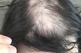 Alopecia and the Emotional Hair Loss