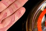 stove with burned hand with heating coil marks