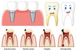 What’s a Root Canal and Why Do You Need One?