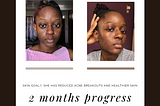 Follow Isabel’s Journey So Far from Acne & Discoloration to Clearer, Healthier Skin.