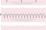 Julie Powell’s Death of “Cardiac Arrest”