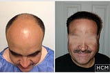 5,000 Grafts Hair Transplant