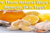 How To Remove Skin Tags Freely?