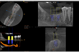 Dental Implants: How Technology Has Revolutionized Treatment Planning