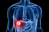 2 Types of Liver Cancer Symptoms to Appear in the Early Stage