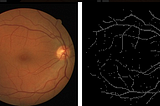 Retina Blood Vessel Segmentation using UNET
