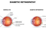 How Diabetic Retinopathy is Cured in Ayurveda?