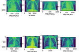 Predicting pneumonia in chest X-Rays