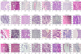 🎗️Gene expression study of breast cancer using Welch Satterthwaite t-test, Kaplan-Meier estimator…