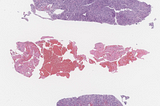 CD10+ Large B-Cell Lymphoma, Arising in the Context of AITL in the Liver