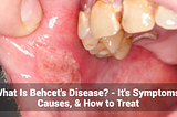 What Is Behcet’s Disease? — Its Symptoms, Causes, & How to Treat