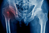 Hip Fracture- All You Need To Know