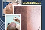 Hair Transplant cost in Chandigarh