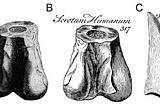 The distal part of a left femur of Megalosaurus from Cornwell, U.K., in posterior view, and first reported by Plot (1677); A, illustrations by Plot (1677, table 8, fig.4); and B, Brookes (1763, p. 312, figure 317) showing the label ‘Scrotum Humanum’. C) Isolated theropod tooth (likely Megalosaurus) from the Stonesfield, U.K., illustrated by Lhuyd (1699, plate 16, figure 1328).