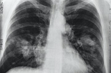 Training Networks to Identify X-rays with Pneumonia