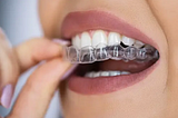5 Things I Wish I’d Known Before Getting Invisalign