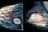 End-to-end breast cancer detection in Python — Part 1