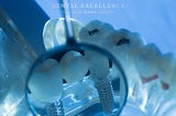 Who can get Dental Implants?